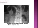 Обзорная рентгенограмма брюшной полости. Видны кишечные арки.
