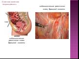 эндоскопическое рассечение спаек брюшной полости. схема эндоскопическое рассечение спаек брюшной полости