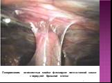 Лапароскопия: плоскостные спайки фиксируют петлю тонкой кишки к передней брюшной стенке