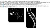 Магнитно-резонансные миелография и цистернография - неинвазивные методики, позволяющие получать высококонтрастные по отношению к веществу мозга изображения ликворных пространств без дополнительного контрастирования. Их применяют, чтобы изучить анатомию ликворных пространств в различных отделах