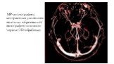 МР-ангиография с контрастным усилением венозных образований ( венография) в полости черепа (3D-обработка).