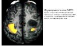 Функциональная МРТ: карта нейрональной активности при активации моторных центров коры мозга у больного с внутримозговой опухолью левой парацентральной зоны.