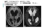 МРТ головного мозга при гидроцефалии. а - врежиме Т1; б - в режиме Т2
