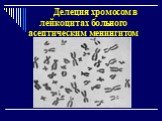 Делеция хромосом в лейкоцитах больного асептическим менингитом