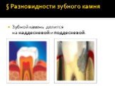 § Разновидности зубного камня. Зубной камень делится на наддесневой и поддесневой.