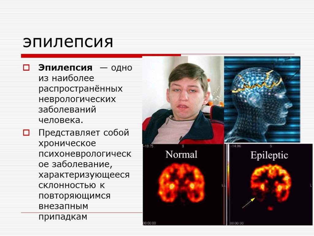 Известные эпилепсии