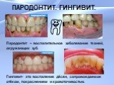 ПАРОДОНТИТ. ГИНГИВИТ. Пародонтит – воспалительное заболевание тканей, окружающих зуб. Гингивит- это воспаление дёсен, сопровождаемое отёком, покраснением и кровоточивостью.