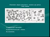 Изменение формы эритроцитов человека при разных типах анемии. А) нормальный гемоглобин; Б) серповидноклеточная анемия; В) талассемия;
