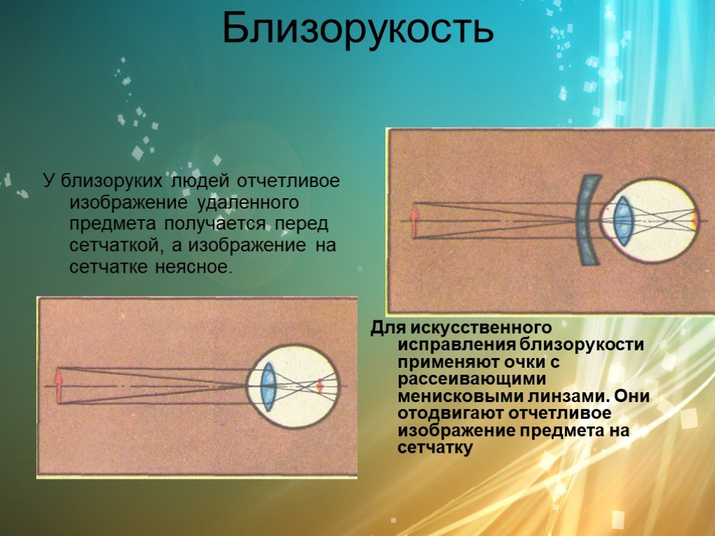 Изображение удаленного предмета. Исправление близорукости. Близорукость изображение перед сетчаткой. Для исправления близорукости применяют. Для коррекции близорукости применяют линзы.