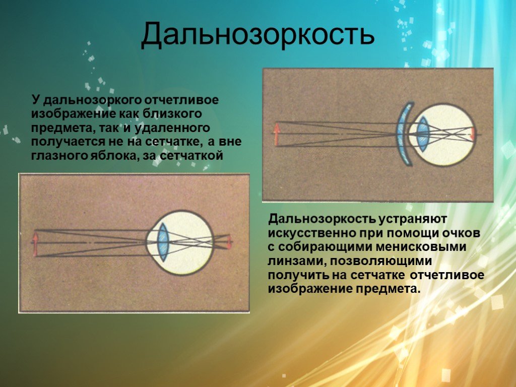 Для получения четкого изображения. Дальнозоркость сетчатка. Изображение при дальнозоркости. Гиперметропия за сетчаткой. При дальнозоркости изображение предмета фокусируется.