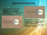 Дальнозоркость. У дальнозоркого отчетливое изображение как близкого предмета, так и удаленного получается не на сетчатке, а вне глазного яблока, за сетчаткой. Дальнозоркость устраняют искусственно при помощи очков с собирающими менисковыми линзами, позволяющими получить на сетчатке отчетливое изобра