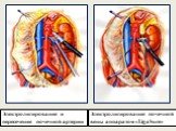 Электролигирование и пересечение почечной артерии. Электролигирование почечной вены аппаратом «LigaSure»