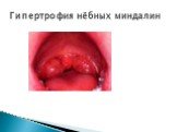 Гипертрофия нёбных миндалин