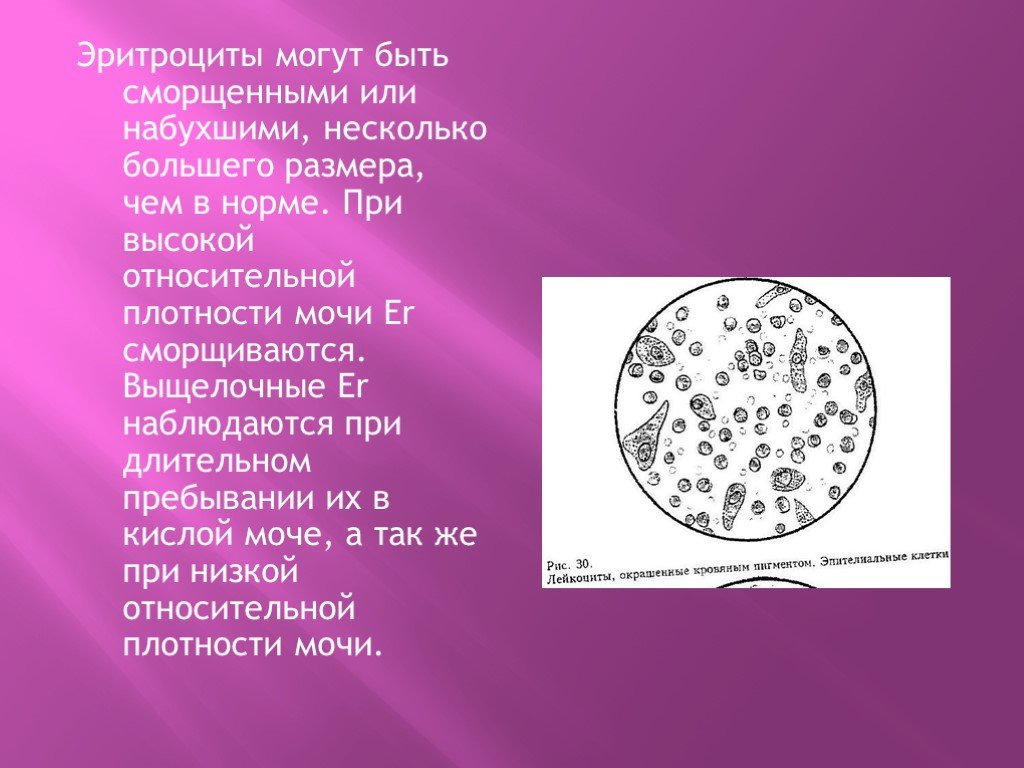 Появление эритроцитов в моче. Эритроциты в моче микроскопия. Измененные и неизмененные эритроциты в моче микроскопия. Эритроциты в моче микроскопия осадка. Неизмененные эритроциты в моче микроскопия.