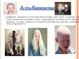 Альбинизм. Альбинизм- врожденное отсутствие пигментации кожи, волос и радужки глаза. Такое отклонение возникает только у рецессивных гомозигот (аа) по данному признаку. В случае рождения гетерозиготной особи (Аа) действие рецессивного гена не проявляется.