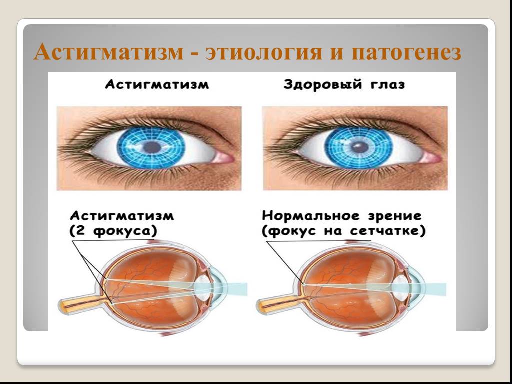 Глаз 0. Миопический астигматизм обоих глаз. Сложный миопический астигматизм ou. Строение глаза астигматизм. Сложный миопический астигматизм левого глаза у ребенка.