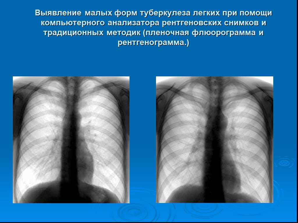 Туберкулез легкого рентгенограмма. Рентген больного туберкулезом. Рентген лёгких здорового человека и туберкулеза. Здоровые легкие на флюорографии и туберкулез.