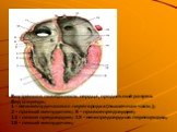 Внутренняя поверхность сердца, продольный разрез. Вид спереди. 1 - межжелудочковая перегородка (мышечная часть); 2 - правый желудочек; 8 - правое предсердие; 12 - левое предсердие; 15 - межпредсердная перегородка; 18 - левый желудочек;