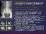 Обзорная урография Экскреторная урография - один из основных рентгенологических методов исследования. Экскреторную урографию выполняют для исследования анатомии почек, лоханок, мочеточников, мочевого пузыря, а также для оценки функционального состояния почек Ретроградная (восходящая) уретеропиелогра