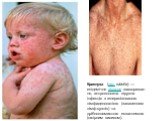 Краснуха (лат. rubella) — епідемічне вірусне захворювання, антропонозна вірусна інфекція з генералізованою лімфаденопатією (запаленням лімф.вузлів) та дрібноплямистою екзантемою (шкірним висипом).