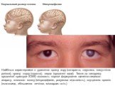Найбільш характерними є ураження органу зору (катаракта, глаукома, помутніння рогівки), органу слуху (глухота), серця (вроджені вади). Також до синдрому вродженої краснухи (СВК) відносять пороки формування щелепно-лицевого апарату, головного мозку (мікроцефалія, розумова відсталість), внутрішніх орг