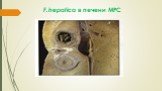 F.hepatica в печени МРС