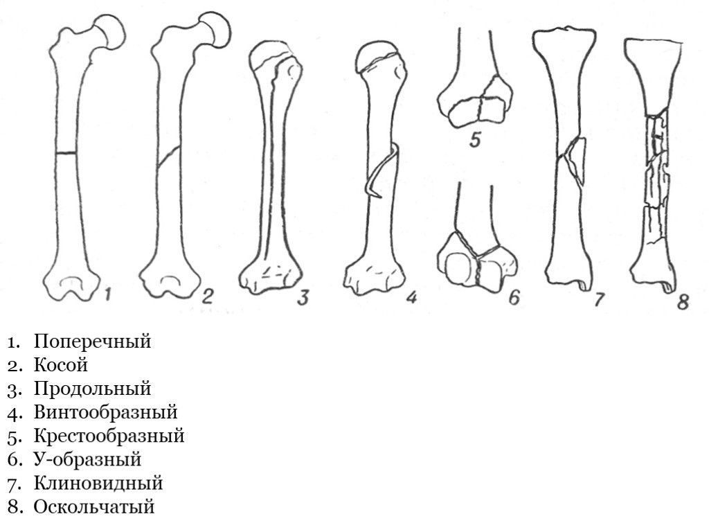 Полная кость. Переломы поперечный, продольный косой винтообразный. Поперечные переломы костей. Поперечный перелом кости. Поперечные косые винтообразные переломы.