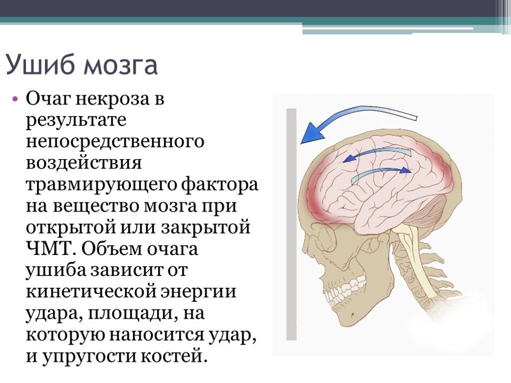 Царапина по сравнению с сотрясением мозга. Небольшое сотрясение мозга. Ушиб головного мозга презентация. Степени головного мозга.