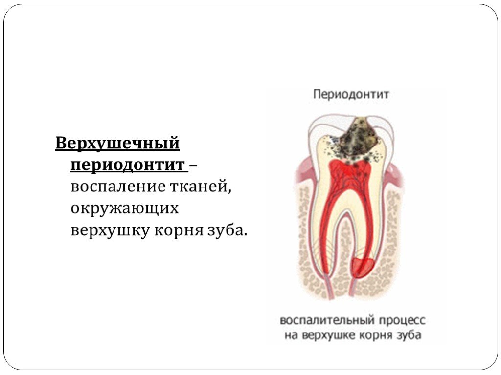 Осложнение лечения периодонтита. Формы острого апикального периодонтита. Гранулематозный апикальный периодонтит. Хронический периодонтит 28 зуба. Острый апикальный периодонтит пульпарного происхождения мкб 10.