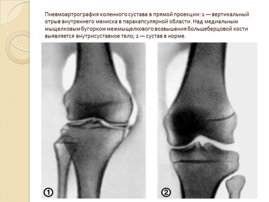Повреждения мыщелка. Мениск коленного сустава рентген. Повреждение мениска на рентгене. Повреждение мениска коленного сустава рентген. Перелом мениска коленного сустава рентген.