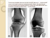 Пневмоартрография коленного сустава в прямой проекции: 1 — вертикальный отрыв внутреннего мениска в паракапсулярной области. Над медиальным мыщелковым бугорком межмыщелкового возвышения большеберцовой кости выявляется внутрисуставное тело; 2 — сустав в норме.