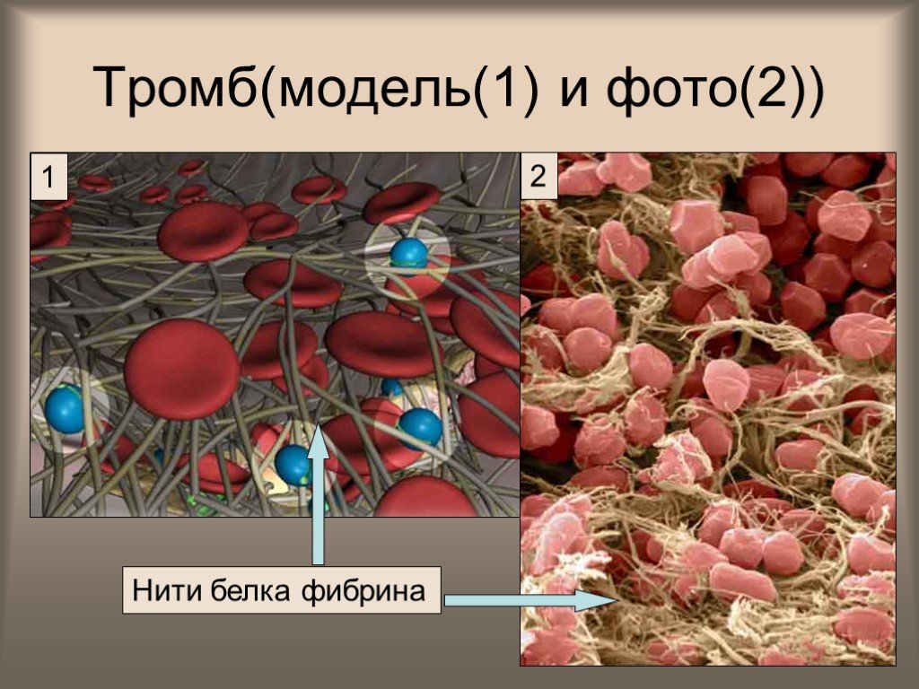Строение тромба. Образование фибрина в крови. Структура тромба.