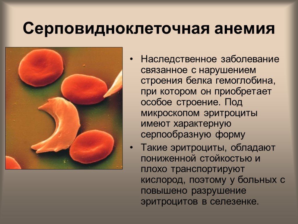 Анемия и эритроциты в крови. Гематологические критерии серповидноклеточной анемии. Серповидноклеточная анемия эритроциты форма. Серповидноклеточная анемия (гемоглобинопатия). Серповидноклеточная анемия плейотропия.