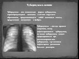 Туберкулема легких. Туберкулема - это клиническая форма туберкулеза, характеризующаяся наличием в легком округлого образования, представляющего собой казеозные массы, продуктивное воспаление и фиброз. Туберкулемы – это как правило следствие, исход инфильтративного туберкулеза, но также туберкулома м