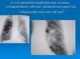 А это флюорографические снимки «нездоровых» лёгких: возможный диагноз – туберкулёз или рак лёгких!