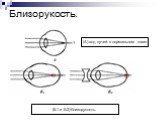 Близорукость. (А) ход лучей в нормальном глазе. (Б1 и Б2) близорукость.