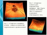 Рис. 7. 3D картина глазного дна. Глаукоматозная экскавация ДЗН. Рядом с диском на сетчатке тень от локального помутнения стекловидного тела. Рис. 7. 3 D картина поражения сетчатки лазером на дискотеке. Субретинальное кровоизлияние.