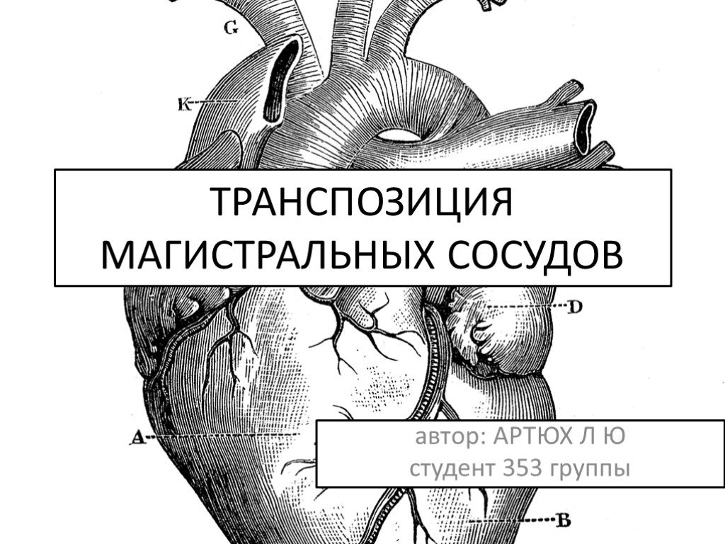 Транспозиция артерий