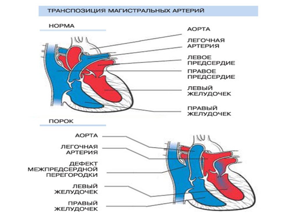 Транспозиция артерий. Врожденный порок сердца транспозиция магистральных сосудов. Транспозиция магистральных сосудов у детей гемодинамика. Транспозиция магистральных артерий у новорожденных. Транспозиция магистральных сосудов гемодинамика схема.