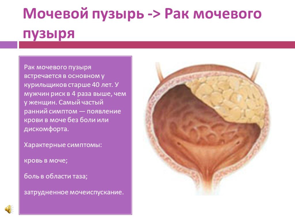 Лечение рака мочевого пузыря у мужчин. Мочевой пузырь. Новообразование мочевого пузыря. Опухоль мочевого пузыря у женщин.