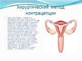 Хирургический метод контрацепции. Метод заключается в перевязке и пересечении маточных труб, которое производится во время операции. В нашей стране стерилизацию делают в основном женщинам во время кесарева сечения и только по просьбе женщины (она пишет специальное заявление). При Советском Союзе сте