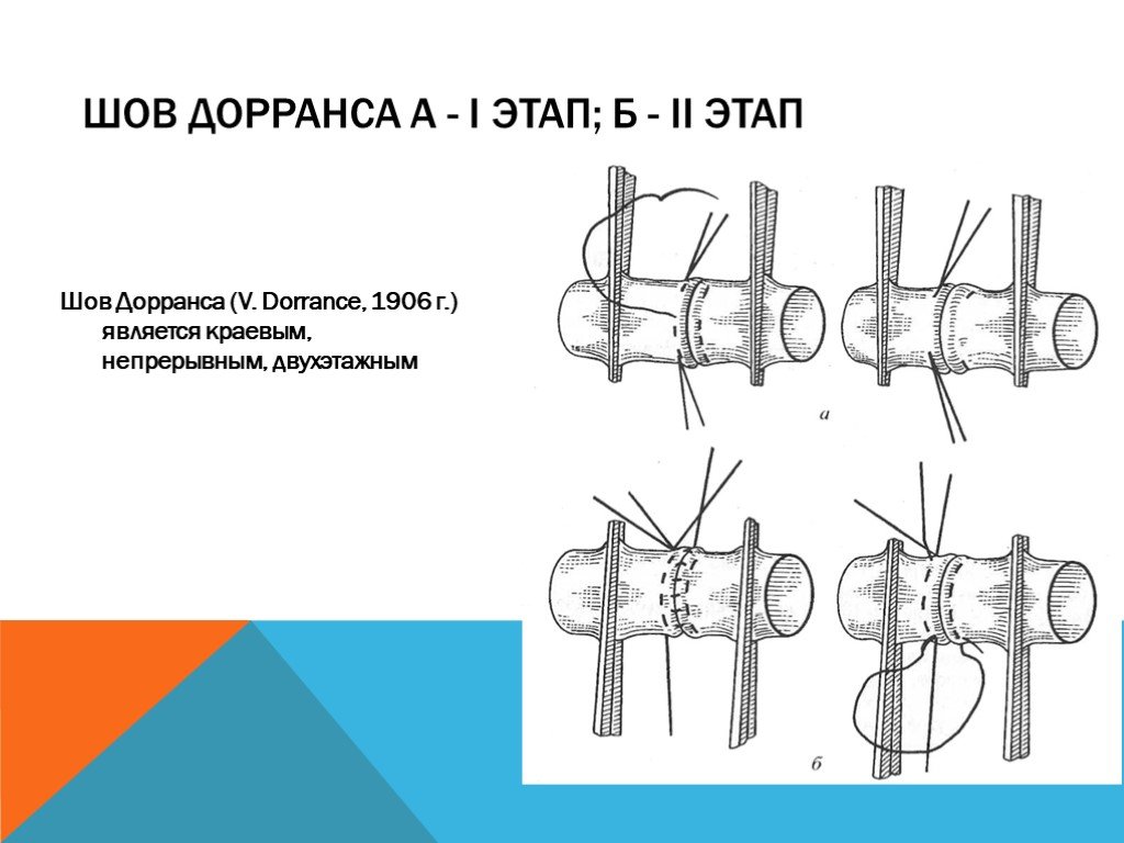 Сосудистый шов история