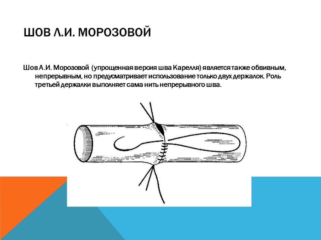 Сосудистый шов методы наложения. Сосудистый шов по Каррелю и Морозовой. Методика наложения сосудистого шва по Каррелю. Шов сосуда по Каррелю Морозовой.