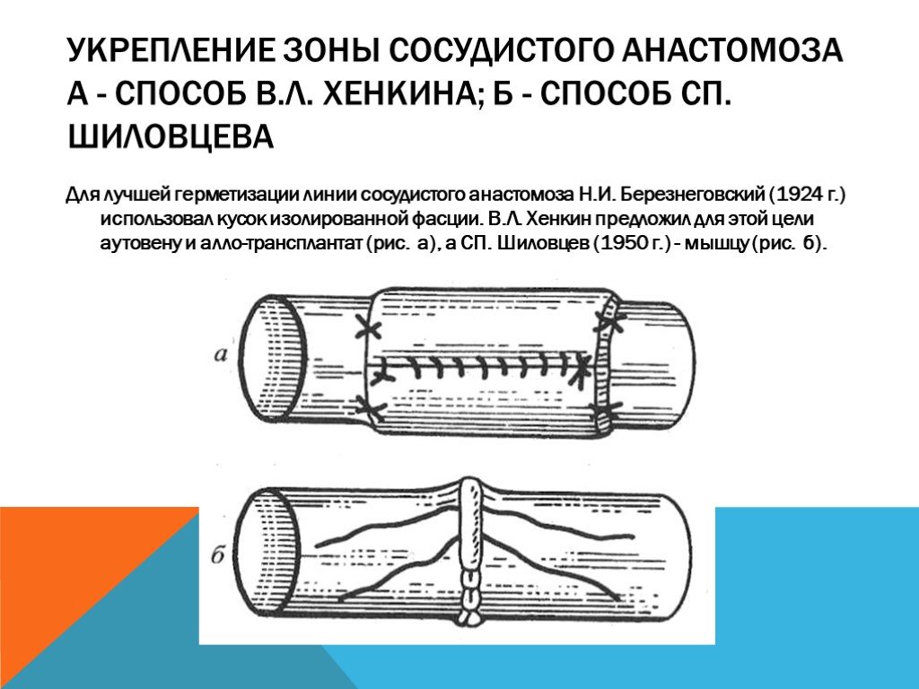 Бесшовное соединение сосудов метод а г коневского. Сосудистый шов Хенкина. Соединение сосудов.