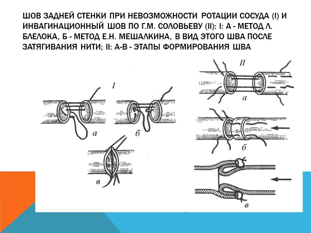 Шов артерий