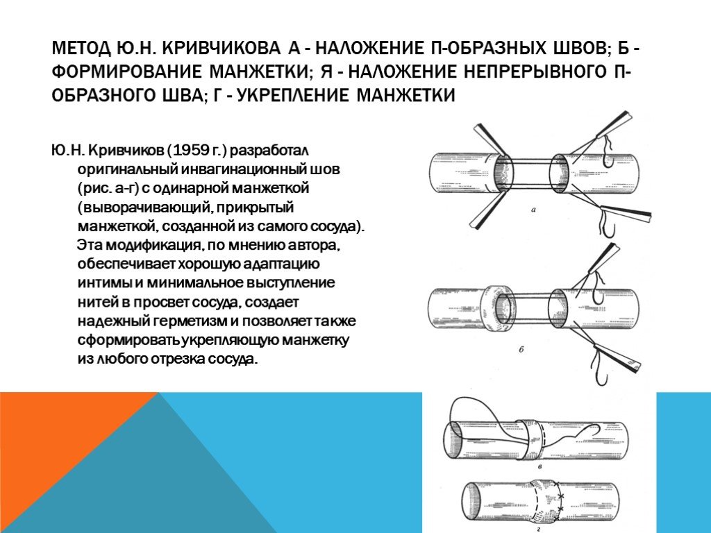 Ю способ. Инвагинационный шов Соловьева. Инвагинационные сосудистые швы Соловьева. Сосудистый шов по Соловьеву. Инвагинационный шов Мерфи.