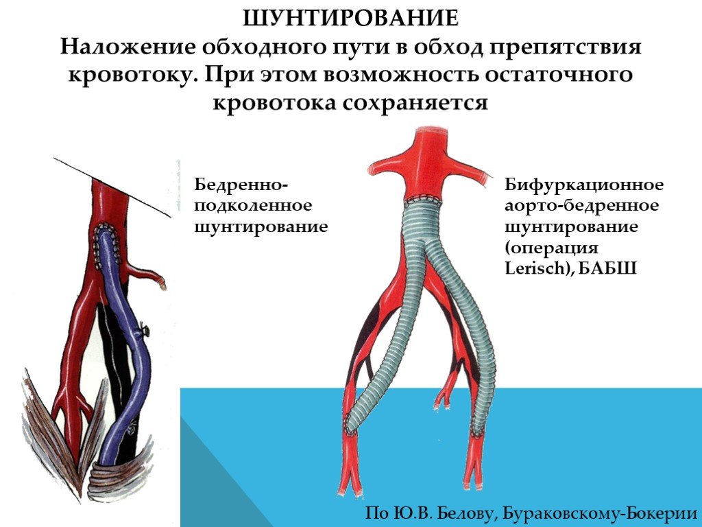 Операция на артерии нижних. Бифуркационное аорто-бедренное шунтирование ход операции. Бедренно подколенное шунтирование техника операции этапы. Схема аортобедренного шунтирования. Аорто бедренная и подколенная шунтирование.