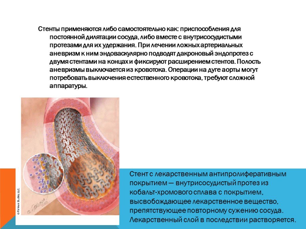 Применять либо. Стент покрытый лекарством. Стенты с лекарственным покрытием. Стенты покрытые и непокрытые. Трансплантация сосудов.