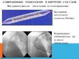СОВРЕМЕННЫЕ ТЕХНОЛОГИИ В ХИРУРГИИ СОСУДОВ. Внутрисосудистая дилатация и стентирование. Балонный катетер со стентом Palmaz. Коронарная ангиограмма до и после процедуры
