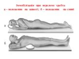Іммобілізація при переломе хребта а - положення на животі; б – положення на спині